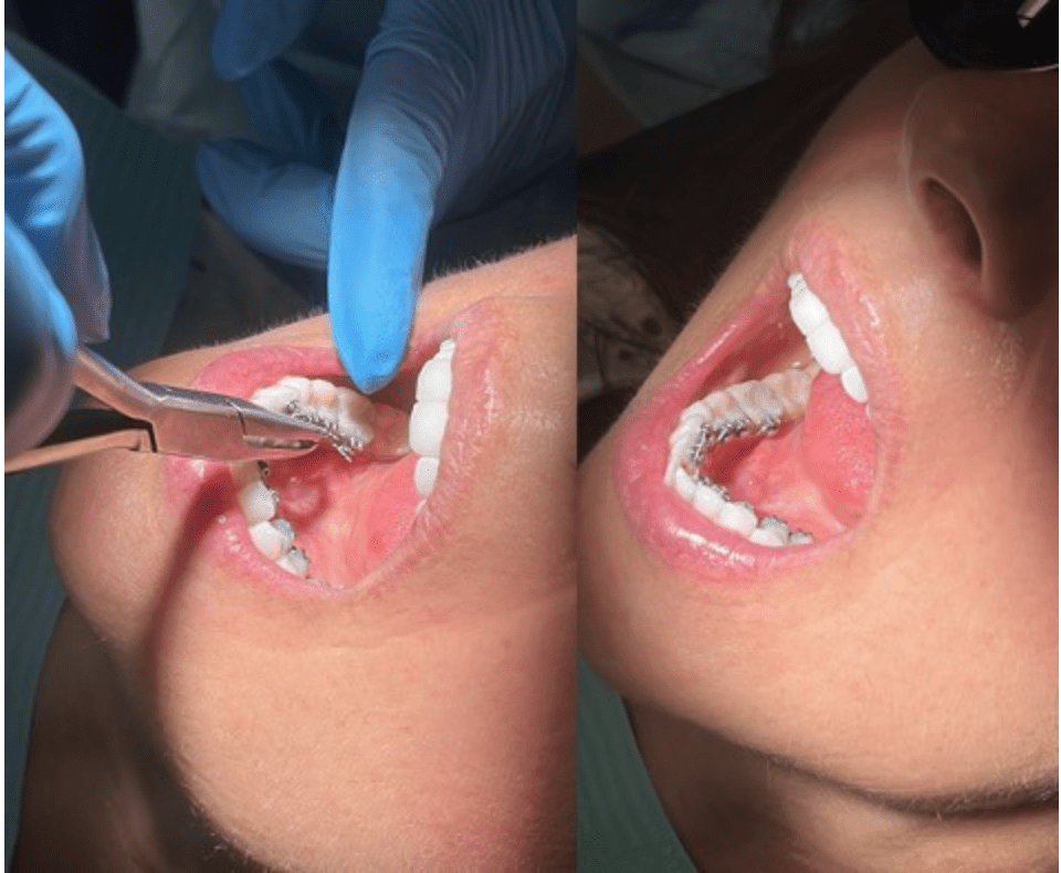 the InBrace Smartwire sits discreetly behind your teeth